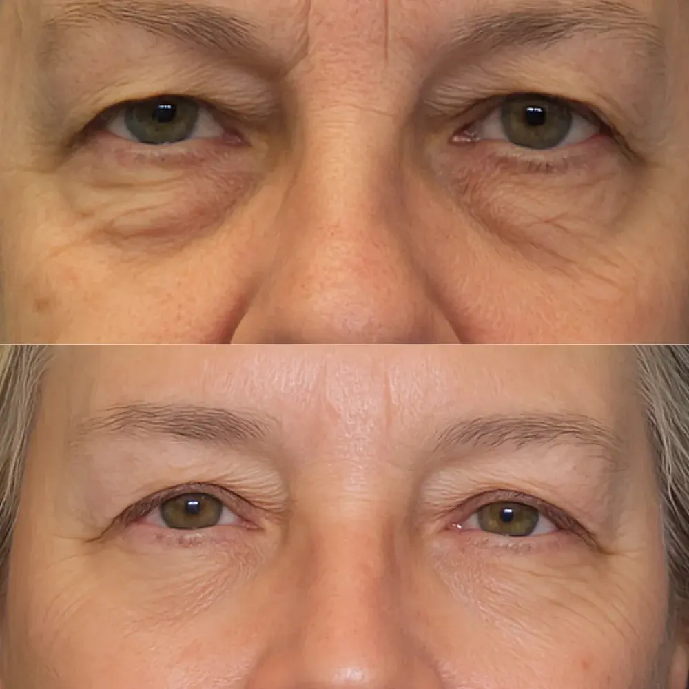 Before and after under-eye result with Sylfirm X RF microneedling at Victoria Rose Aesthetics