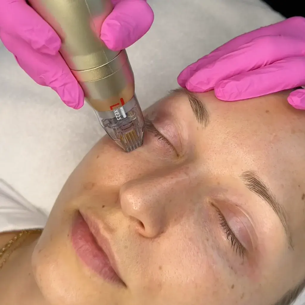 sylfirm x rf microneedling under eye pickering