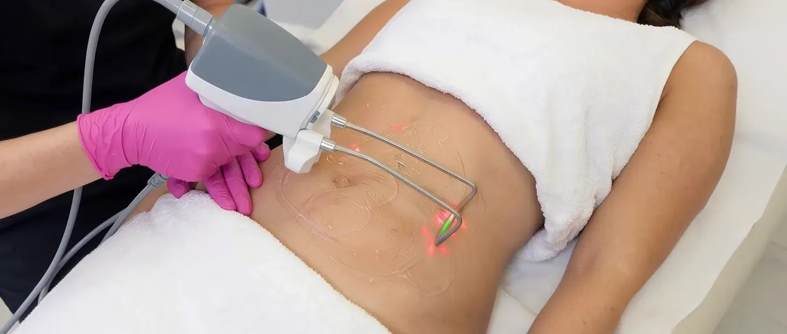 Fotona TightSculpting