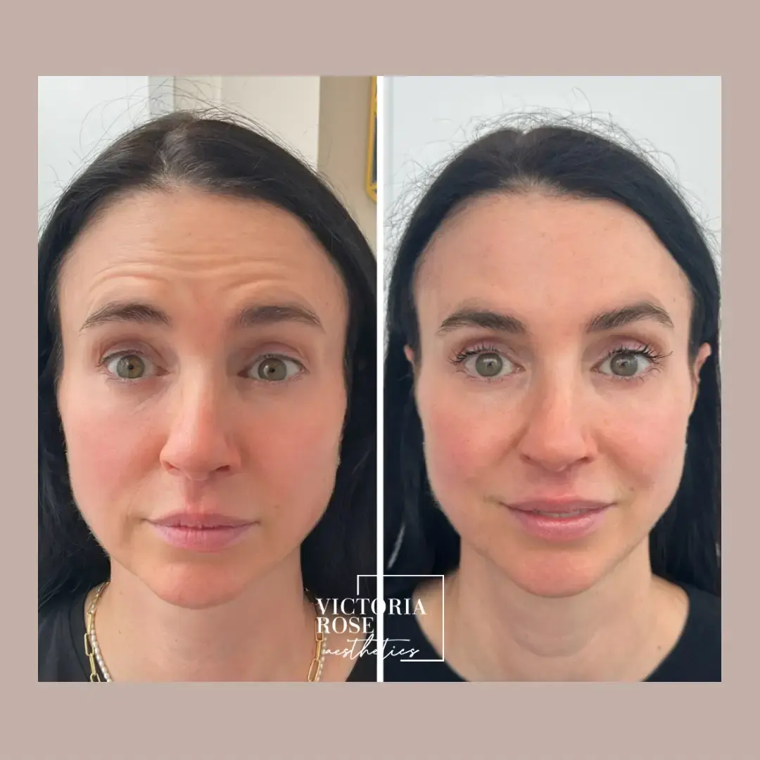 botox before and after pickering