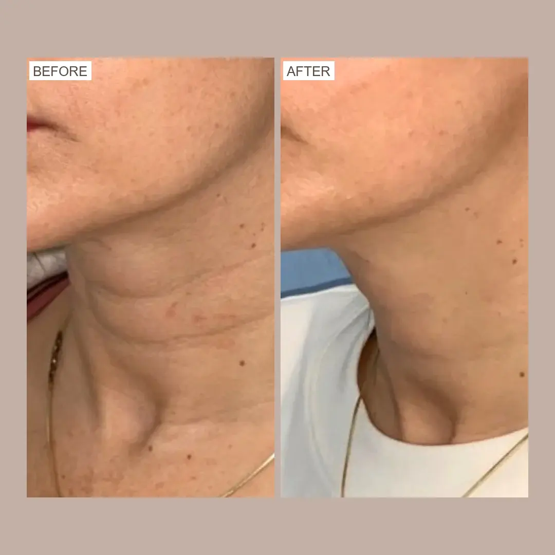 sofwave neck lift before and after