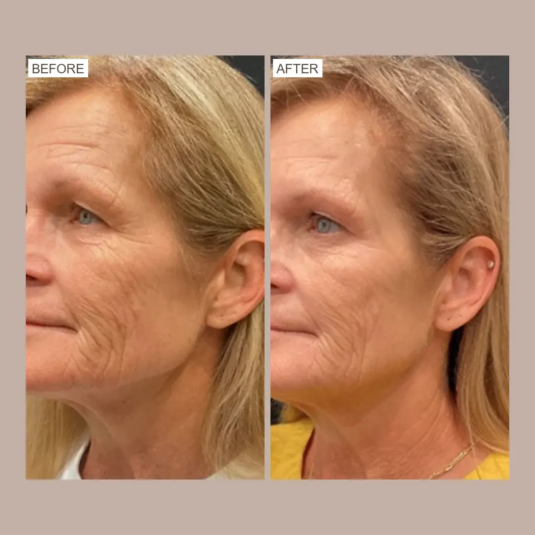 sofwave jowls & lower face before and after