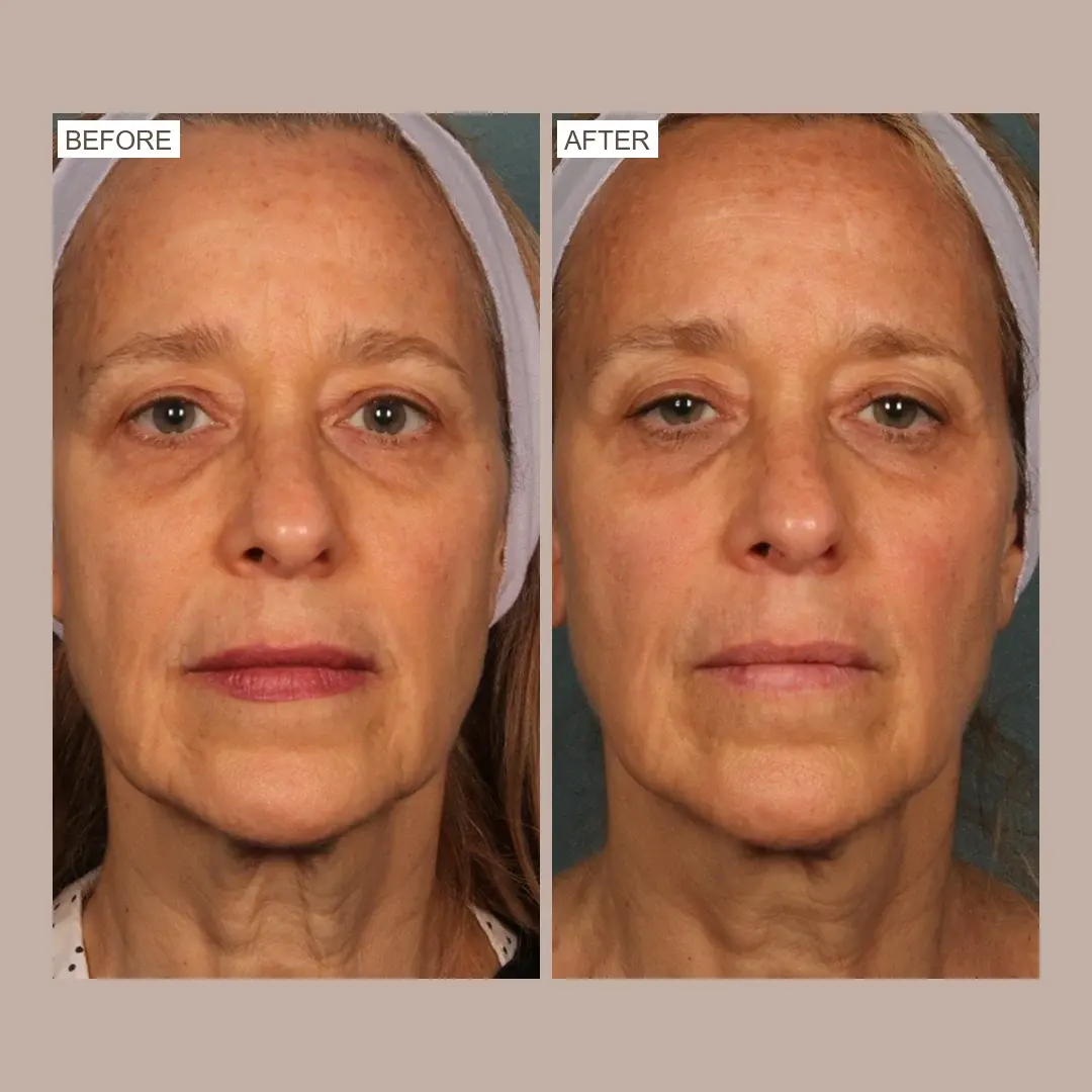 sofwave skin tightening before and after
