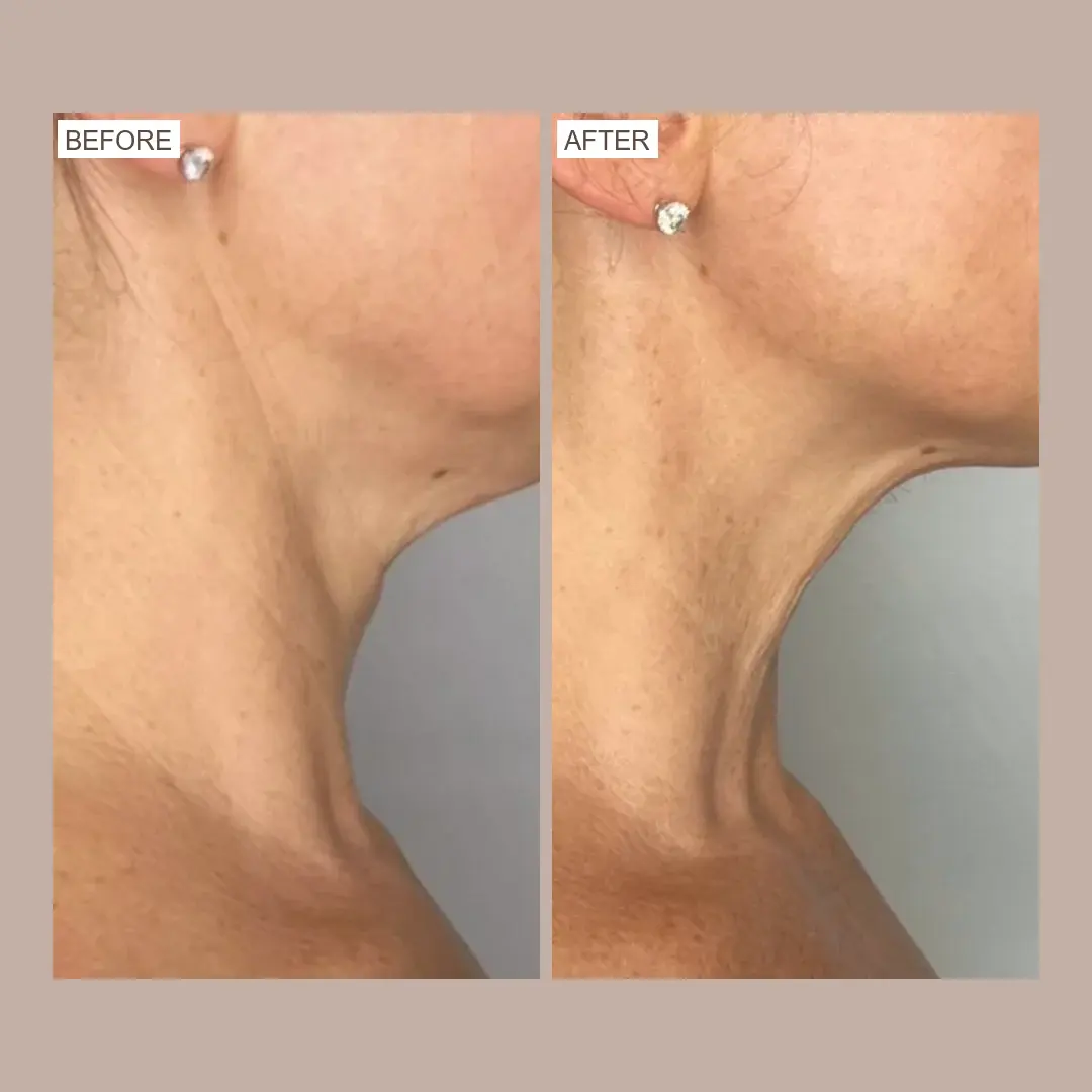 sofwave jawline tightening before and after