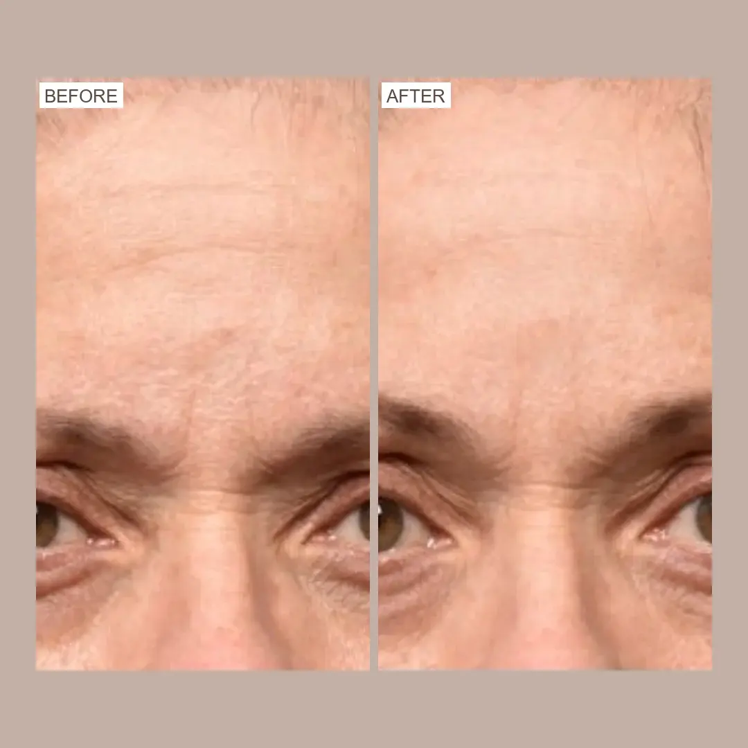 sofwave forehead & brow lift before and after