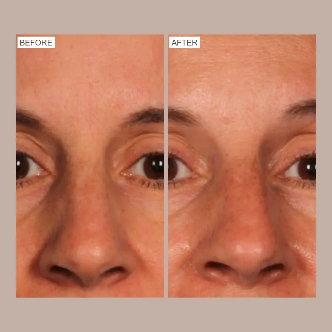sofwave forehead & brow lift before and after
