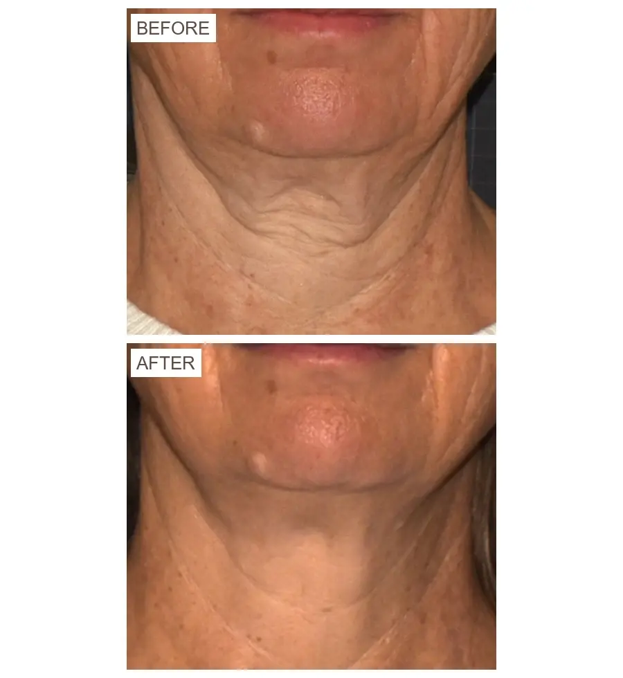 sofwave neck before and after