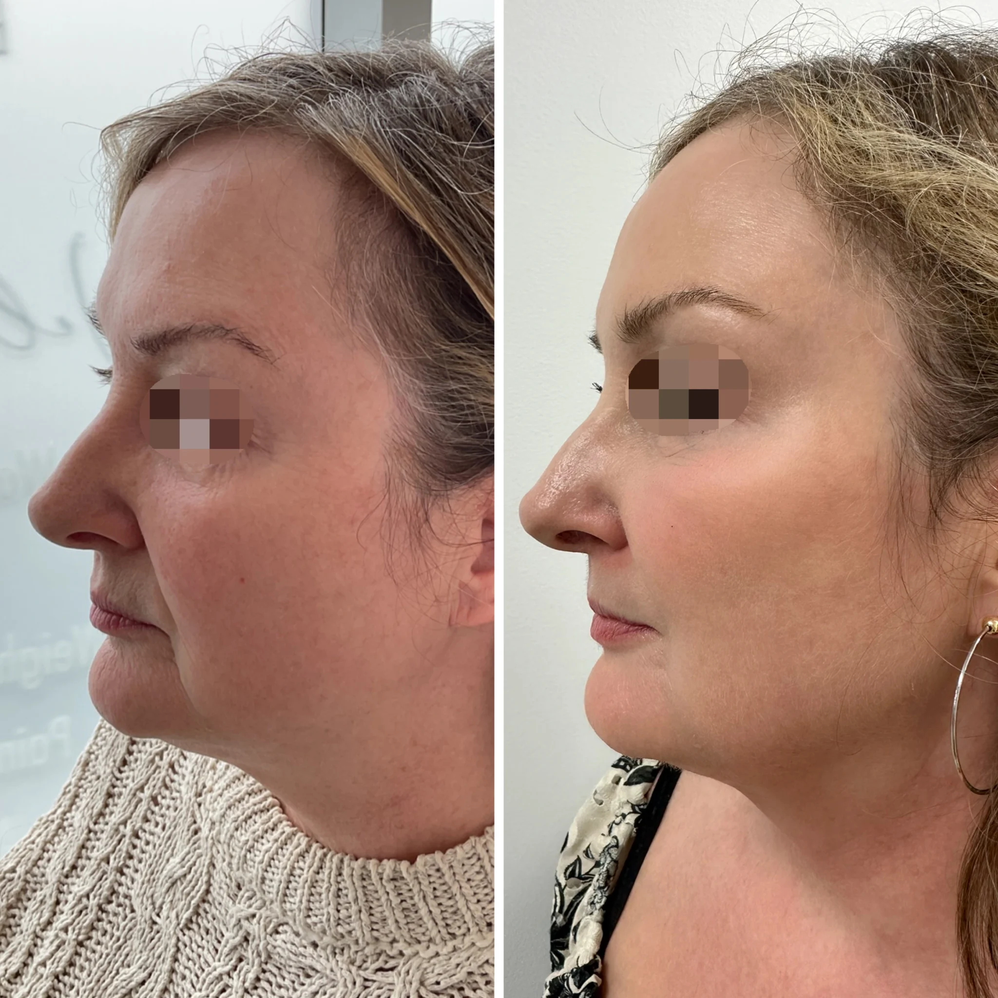 Facial-balancing