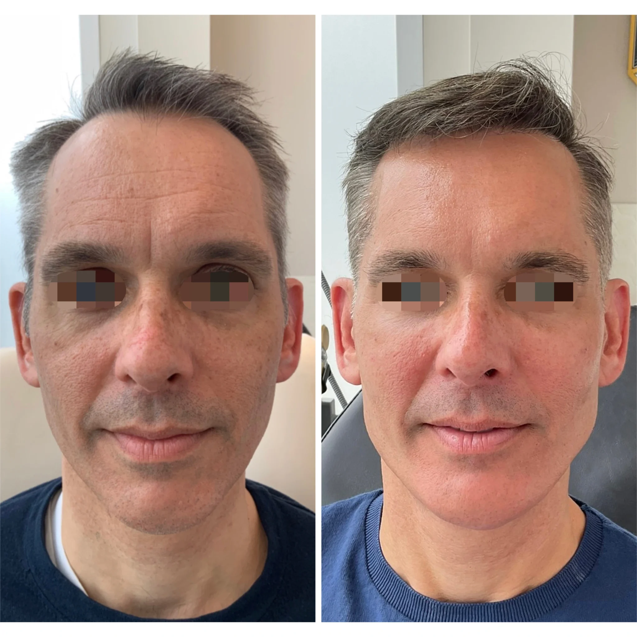 facial balancing for men