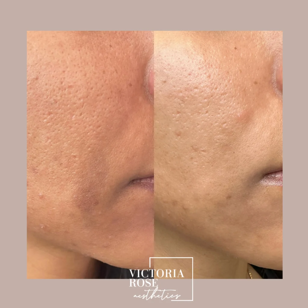 Microneedling-scar-reduction