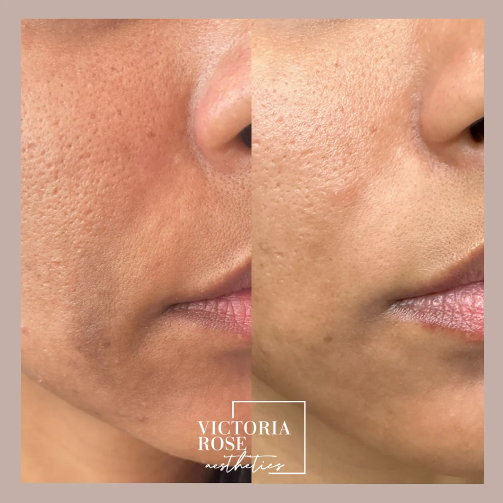 Microneedling-scar-reduction-b_a