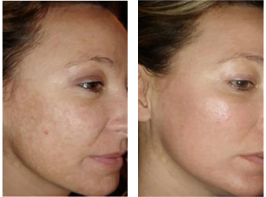 RF microneedling before and after