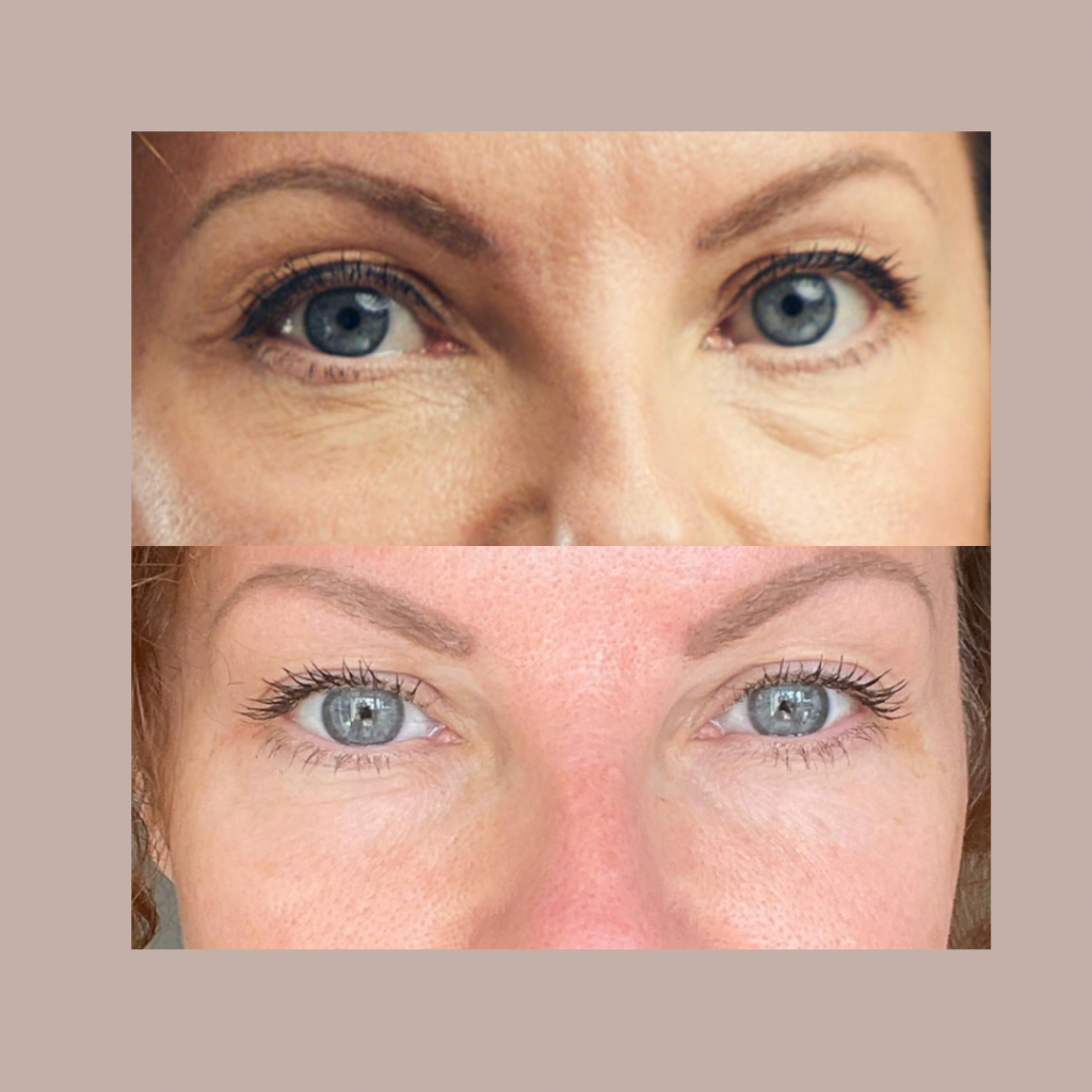 non surgical eyelid lift