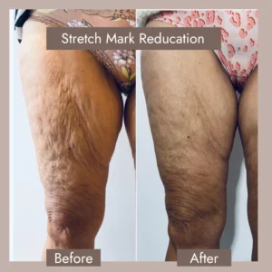 Laser Stretch Mark Removal Before After​