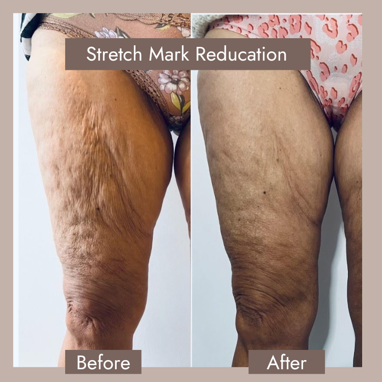 laser stretch mark removal before after​