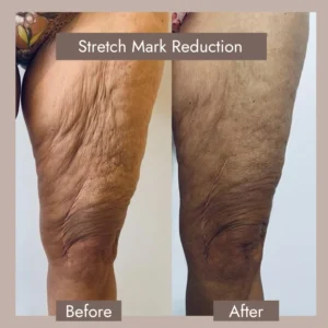 Stretch Marks and Laser Treatment​