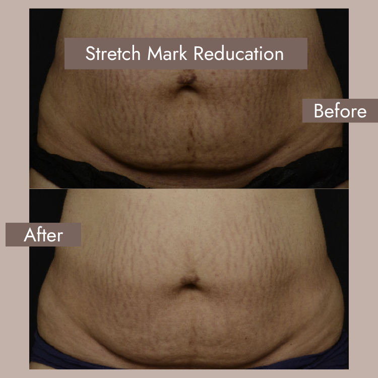 Laser Stretch Mark Removal Before and After​