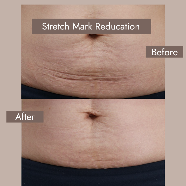 stretch marks before and after​