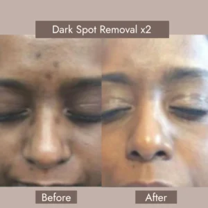 Dark Spot Remover on Face​