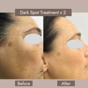 Before and After Hyperpigmentation​