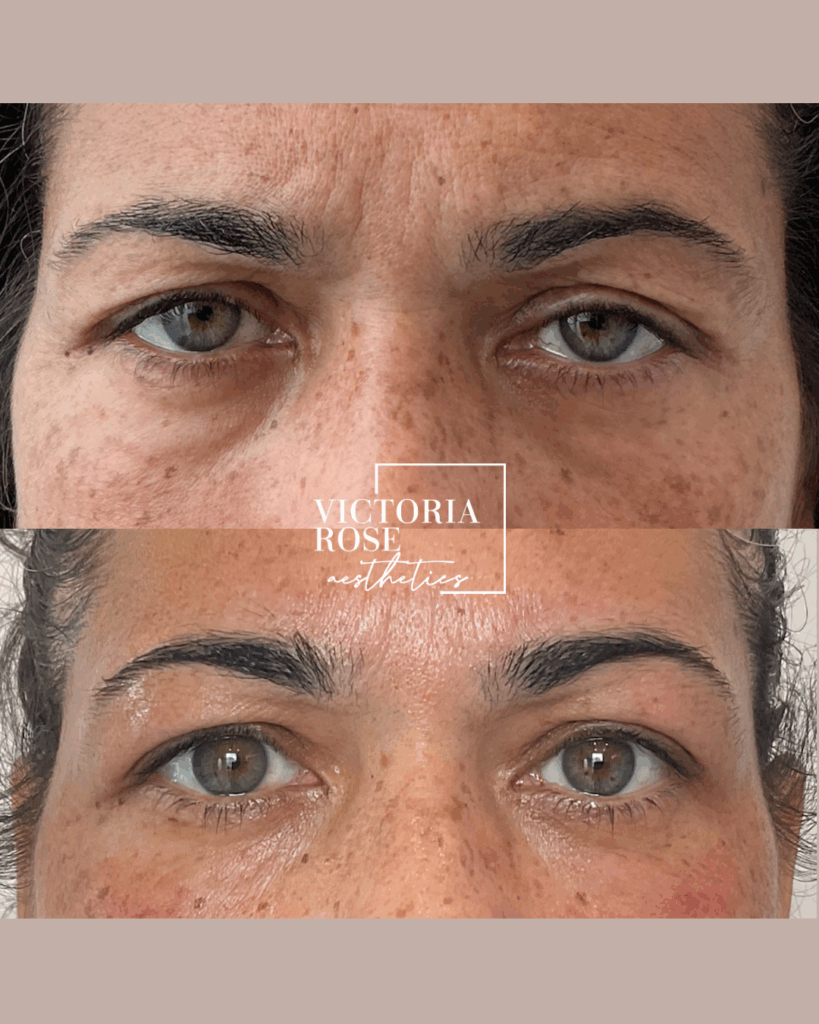 non surgical eyelid lift before and afters