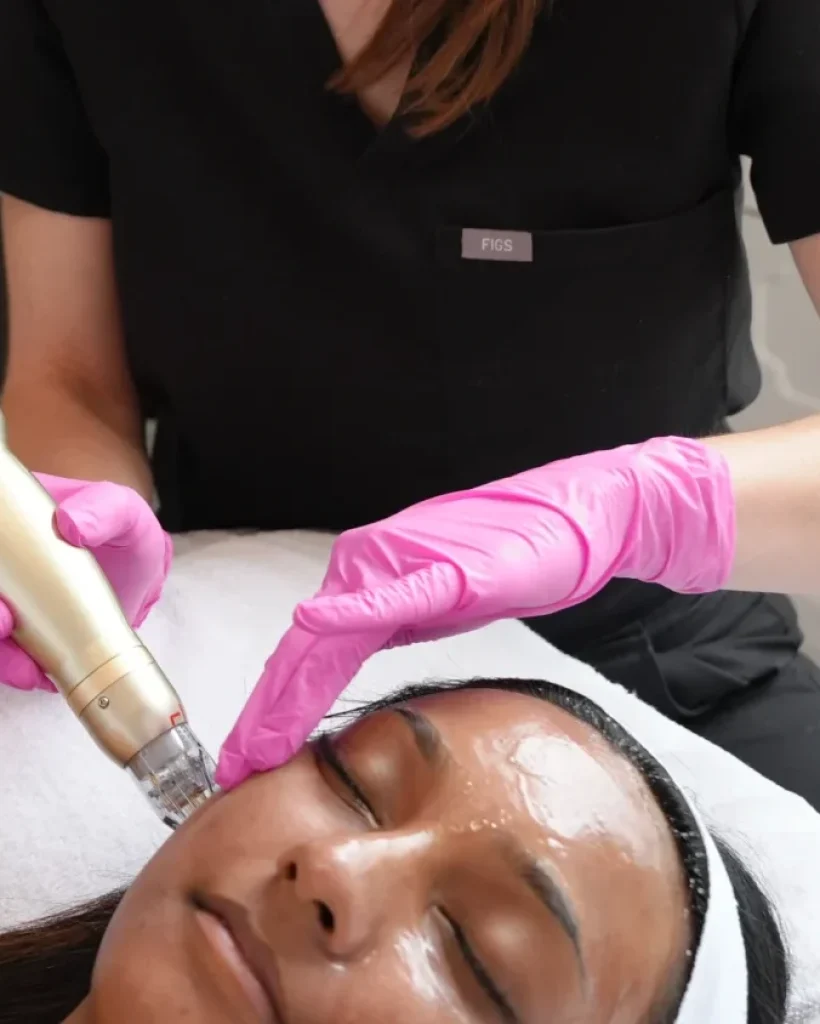 rf microneedling